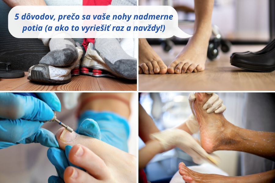5 dôvodov nadmerného potenie nôh