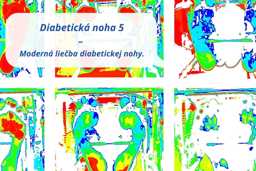 Moderne metody liečby diabetickej nohy