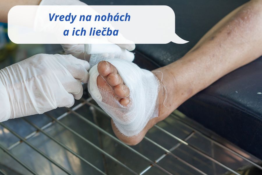 Vredy na nohách a ich liečba